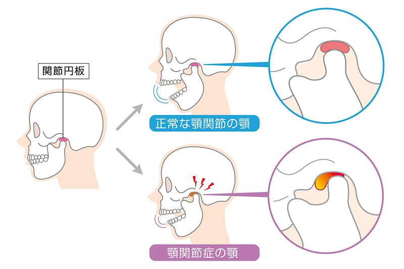 顎関節症の症状改善